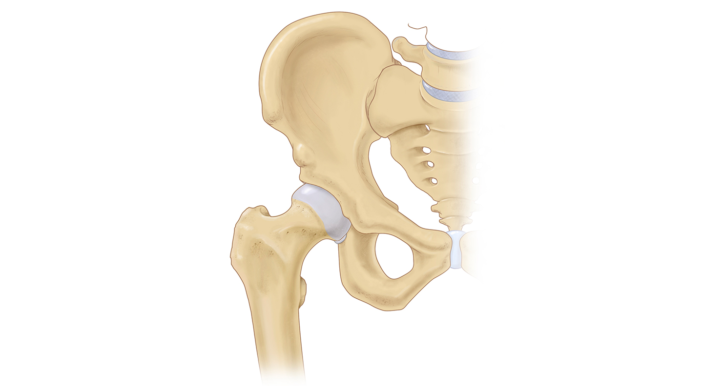 Illustration of hip joint with athletic injury labral tear
